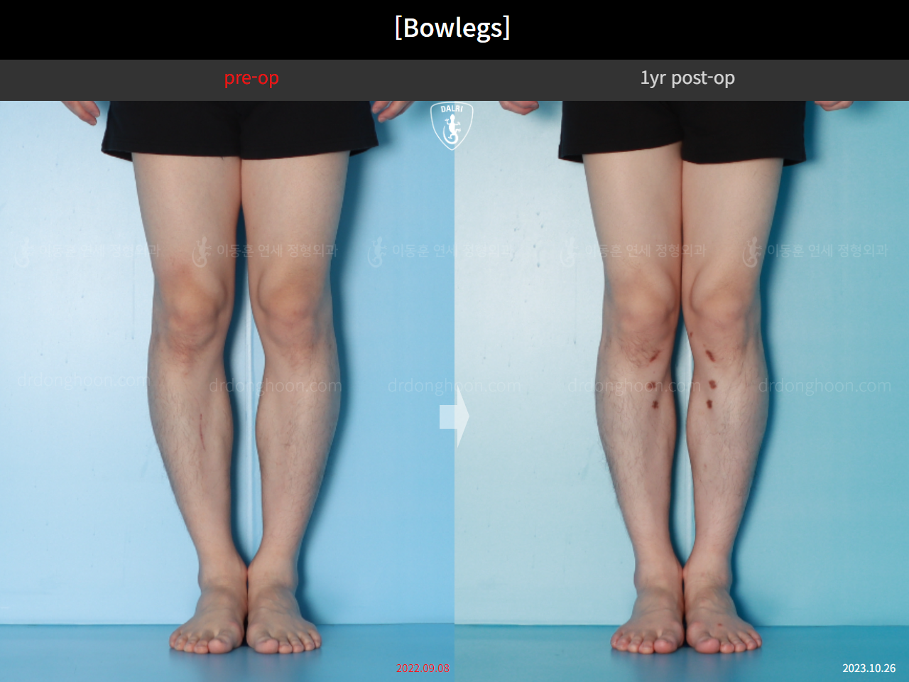 Before and after adult bowlegs, case 16724494, image 7, Dr. Donghoon institute (DALRI)