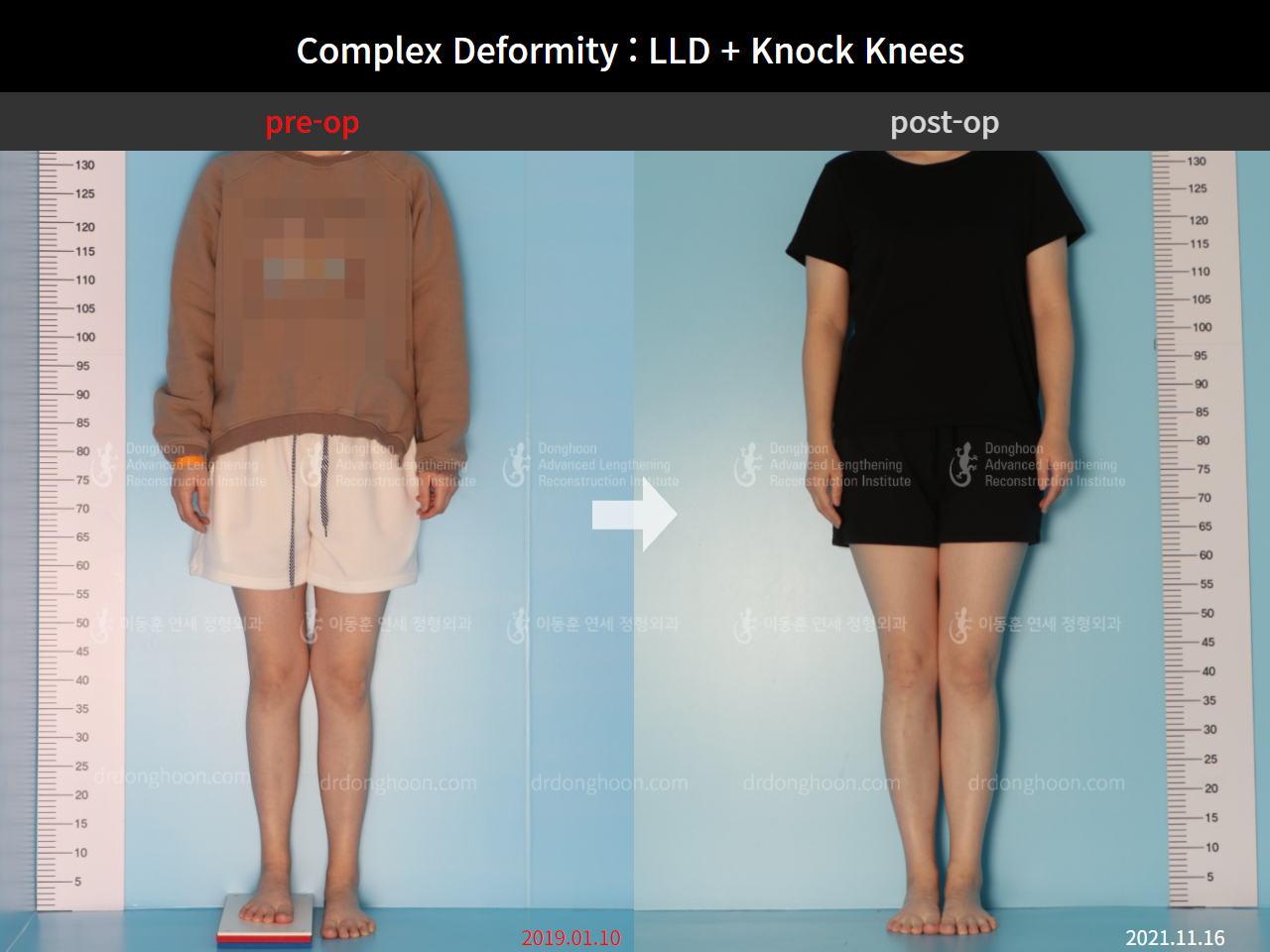 Before and after adult lld, case 9041582, image 6, Dr. Donghoon institute (DALRI)