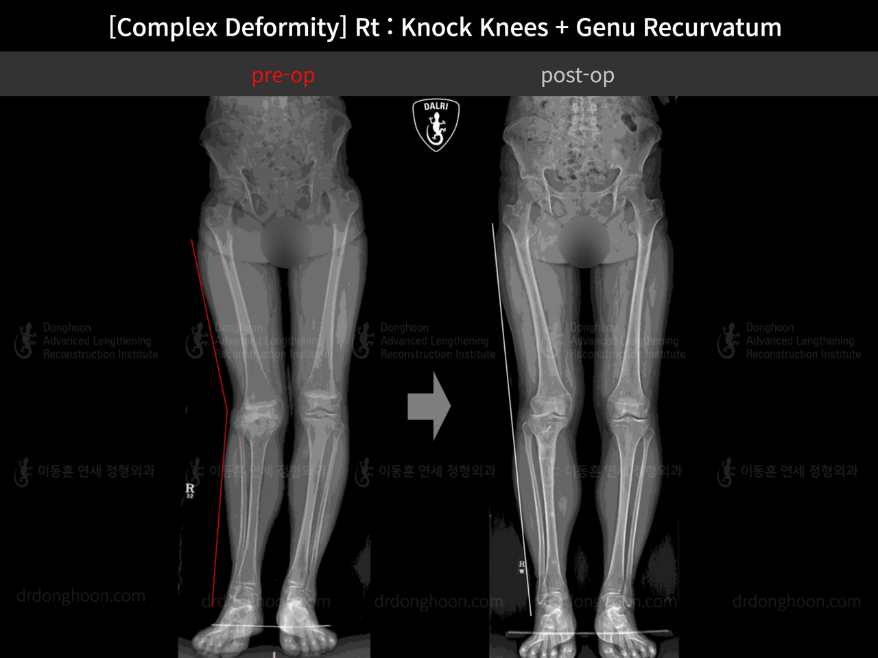 Before and after complex deformity, case 13204696, image 7, Dr. Donghoon institute (DALRI)