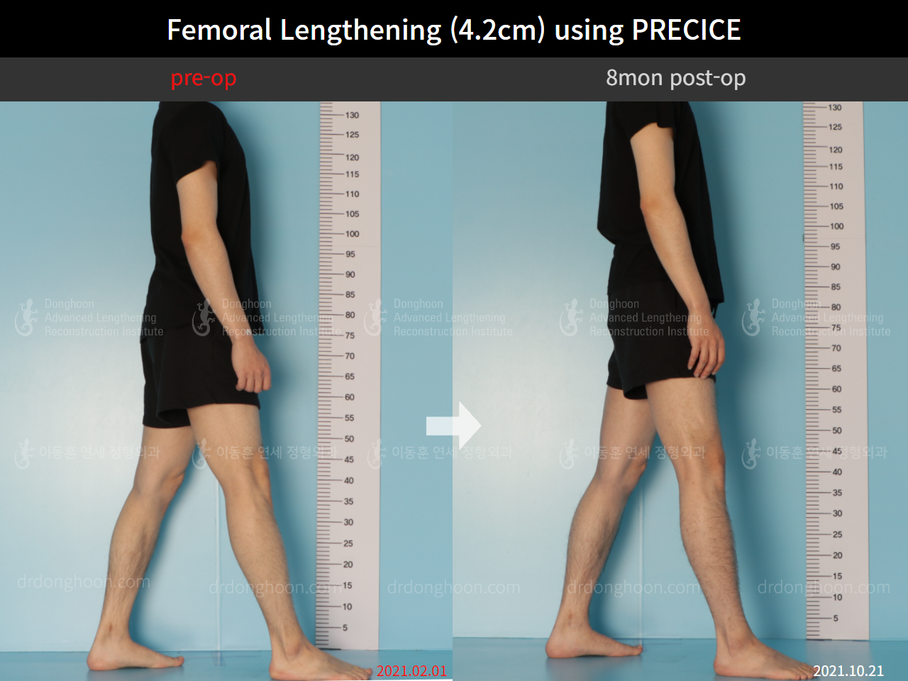 Before and after cll precice, case 8781700, image 3, Dr. Donghoon institute (DALRI)