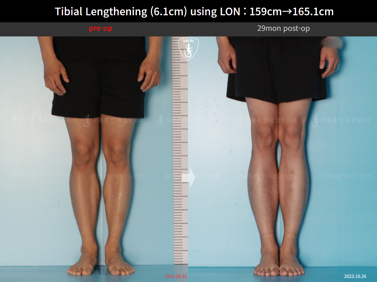 Before and after cll lon, case 16723424, image 7, Dr. Donghoon institute (DALRI)