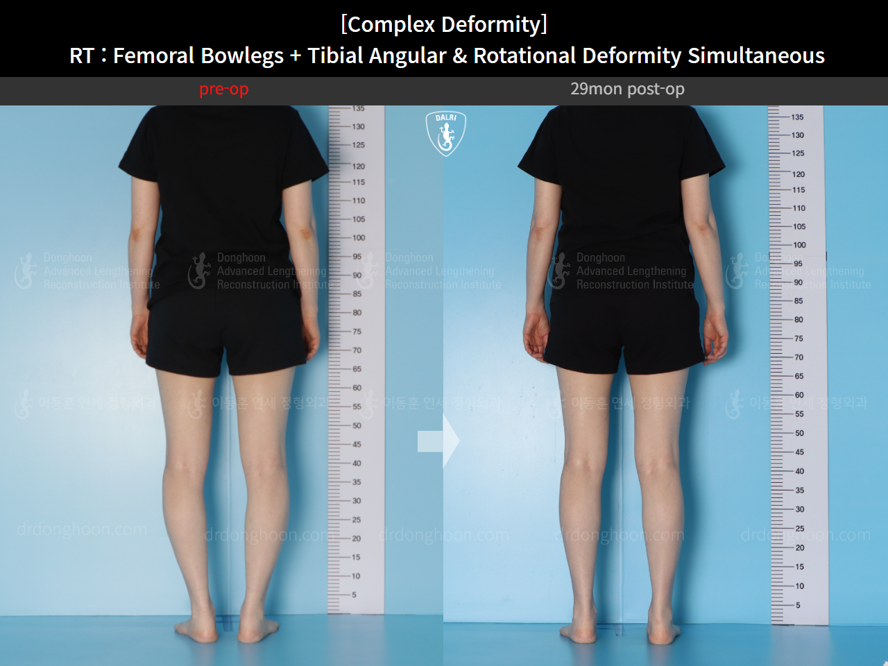 Before and after adult bowlegs, case 14771490, image 5, Dr. Donghoon institute (DALRI)