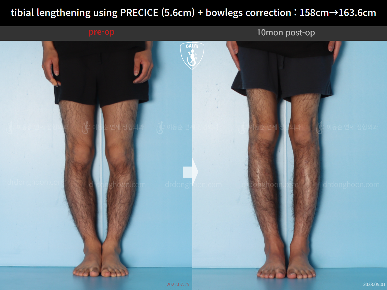 Before and after cll precice, case 15043786, image 4, Dr. Donghoon institute (DALRI)