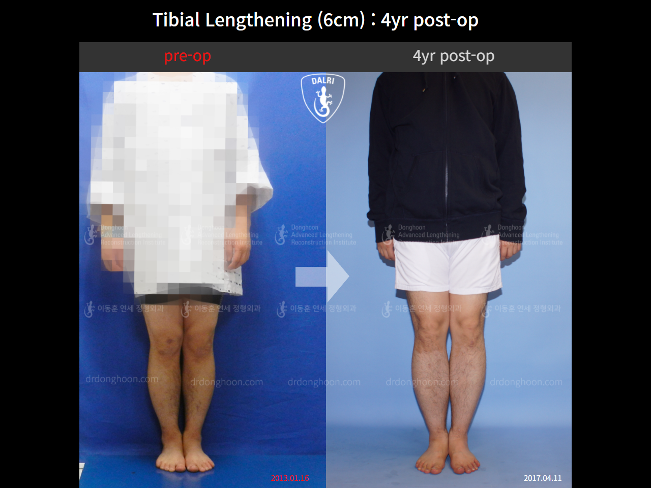 Before and after cll lon, case 10474212, image 1, Dr. Donghoon institute (DALRI)