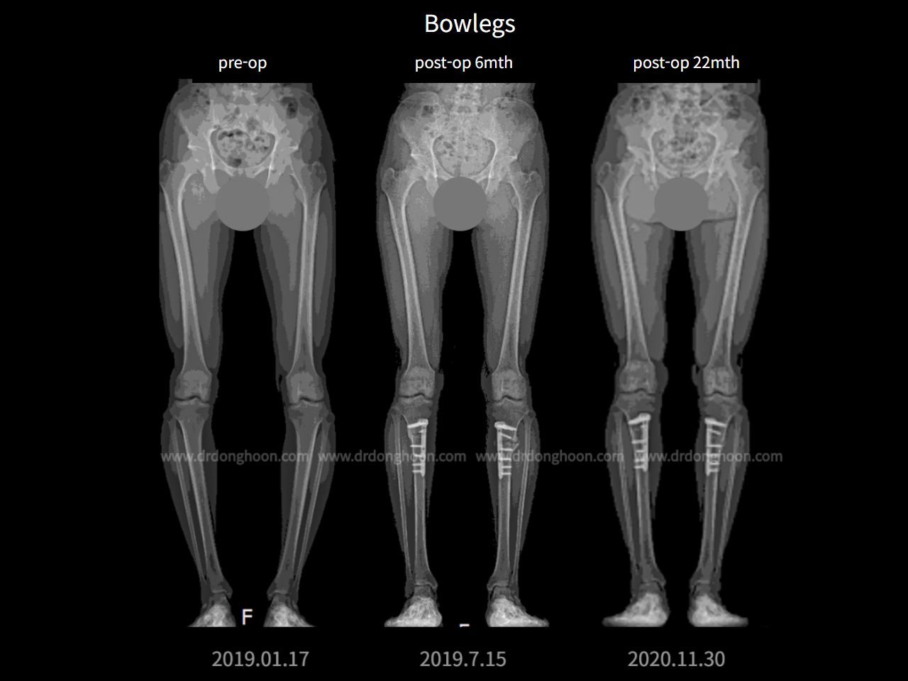 Before and after adult bowlegs, case 6779434, image 1, Dr. Donghoon institute (DALRI)