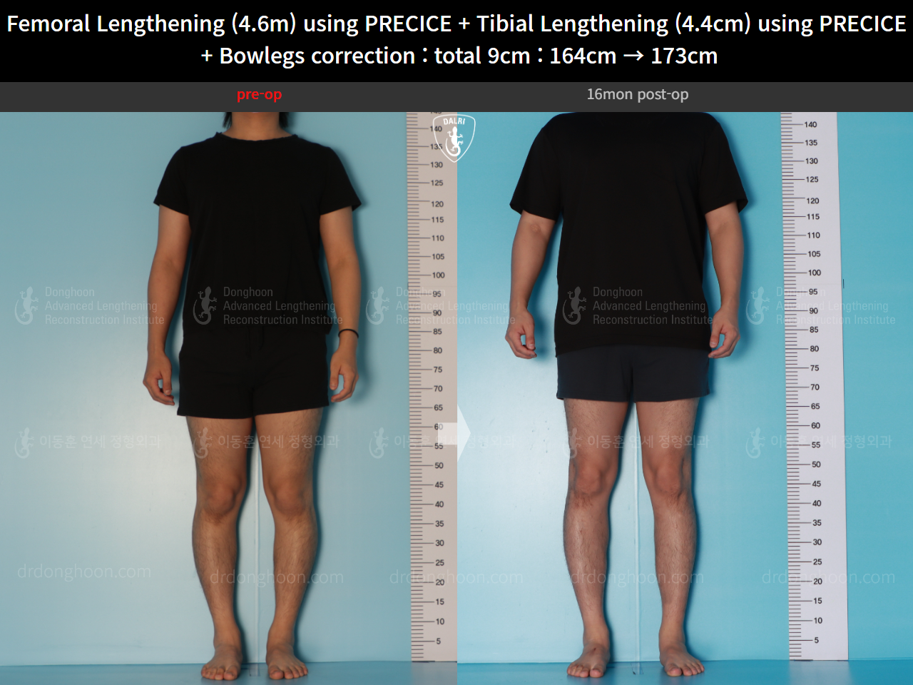 Before and after cll precice, case 16697524, image 2, Dr. Donghoon institute (DALRI)