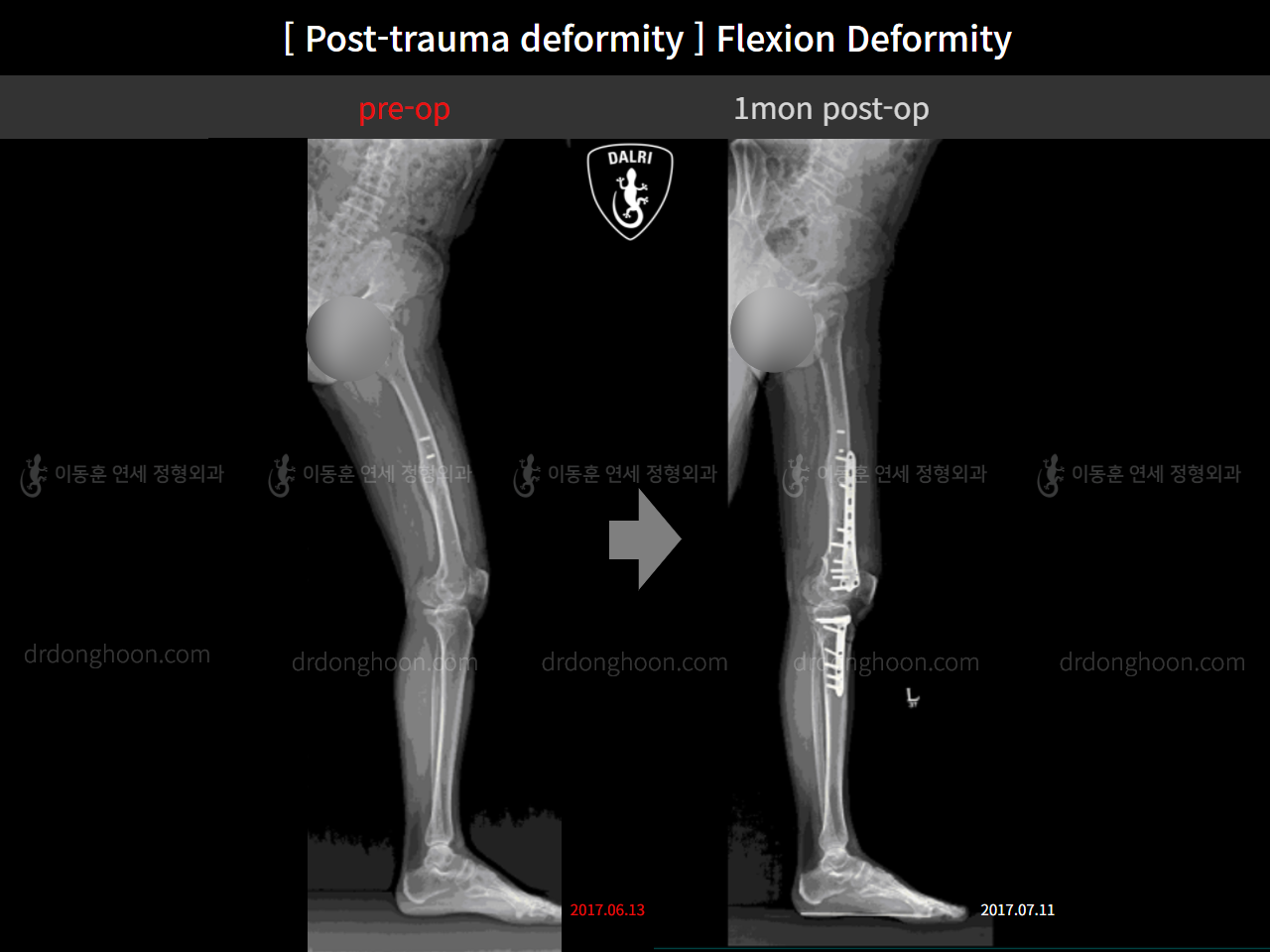 Before and after flexion deformity, case 11231117, image 1, Dr. Donghoon institute (DALRI)