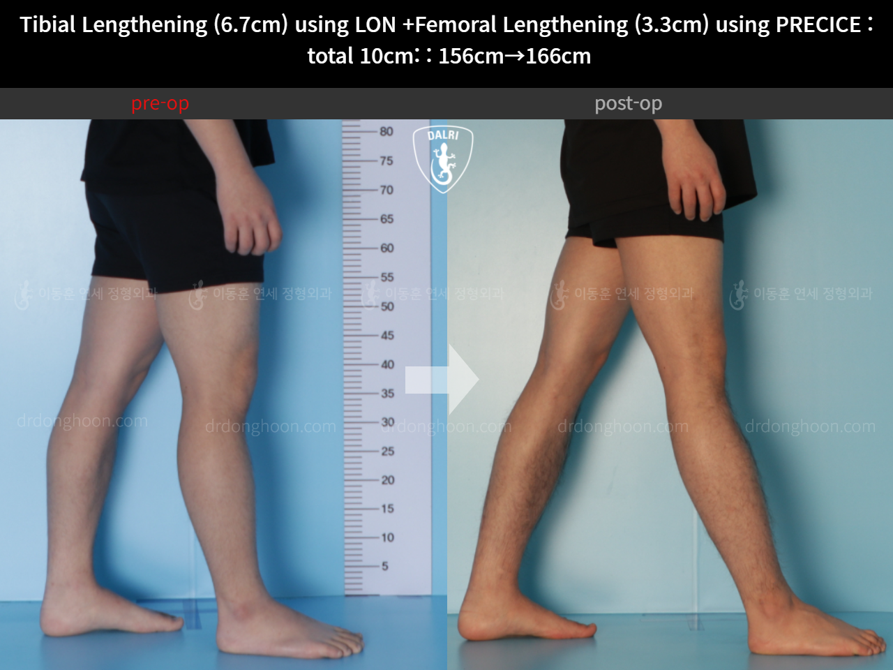 Before and after cll lon, case 11044268, image 7, Dr. Donghoon institute (DALRI)