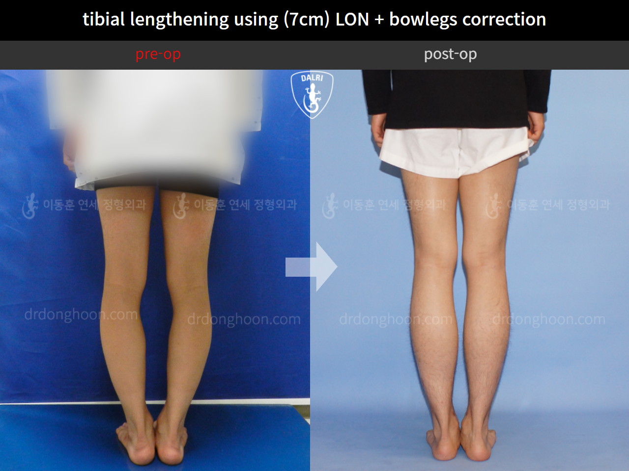 Before and after cll + deformity correction, case 4323143, image 4, Dr. Donghoon institute (DALRI)