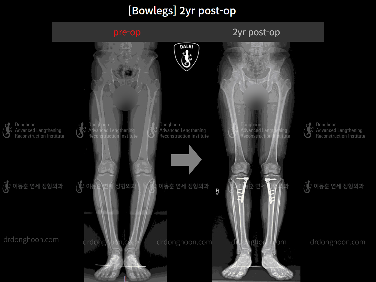 Before and after adult bowlegs, case 4311027, image 5, Dr. Donghoon institute (DALRI)