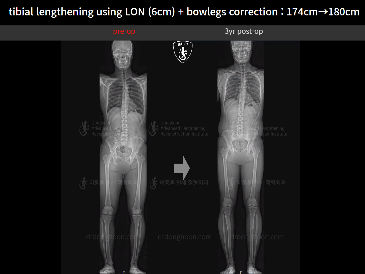 Before and after cll + deformity correction, case 18228446, image 1, Dr. Donghoon institute (DALRI)