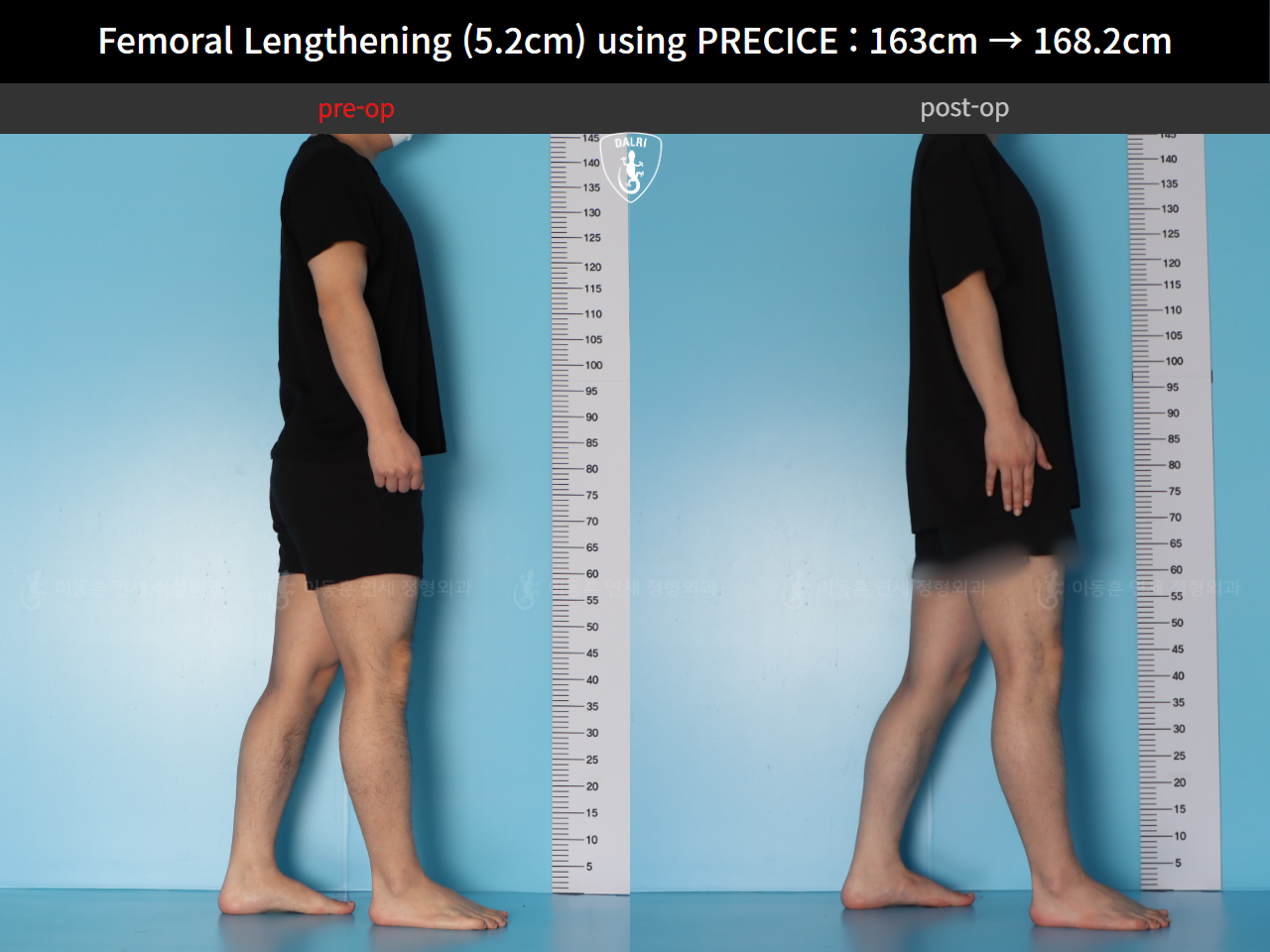 Before and after cll precice, case 55585697, image 5, Dr. Donghoon institute (DALRI)