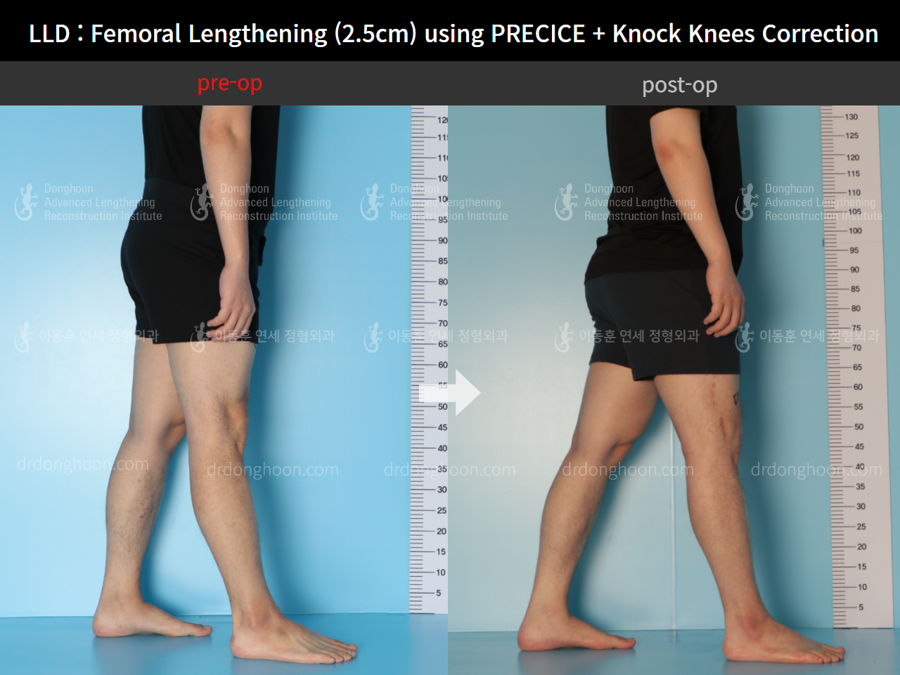 Before and after adult lld, case 9016415, image 3, Dr. Donghoon institute (DALRI)