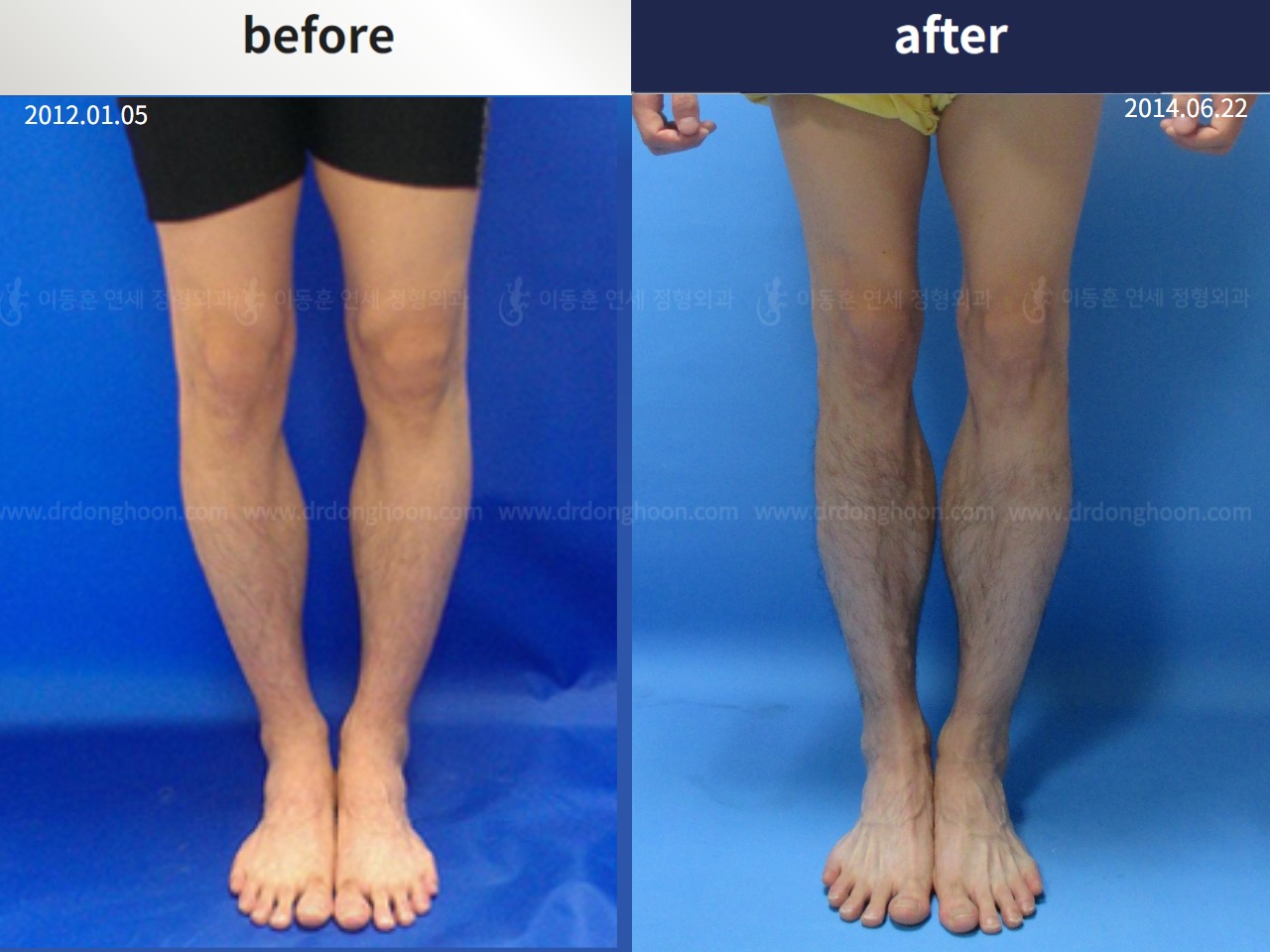 Before and after cll + deformity correction, case 4323086, image 1, Dr. Donghoon institute (DALRI)