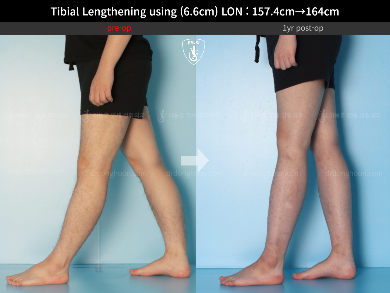 Before and after cll lon, case 13418098, image 8, Dr. Donghoon institute (DALRI)