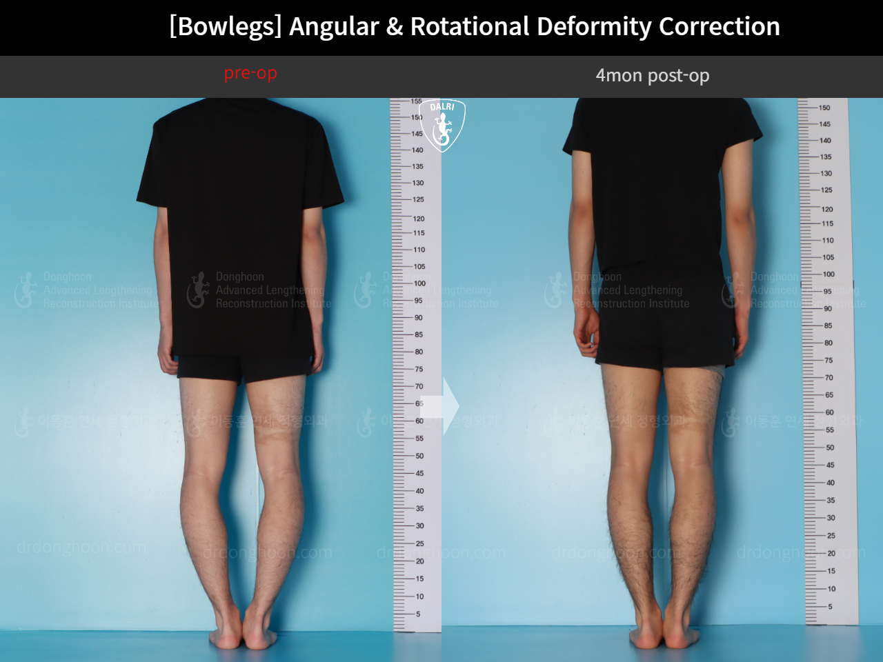 Before and after adult bowlegs, case 18071382, image 4, Dr. Donghoon institute (DALRI)
