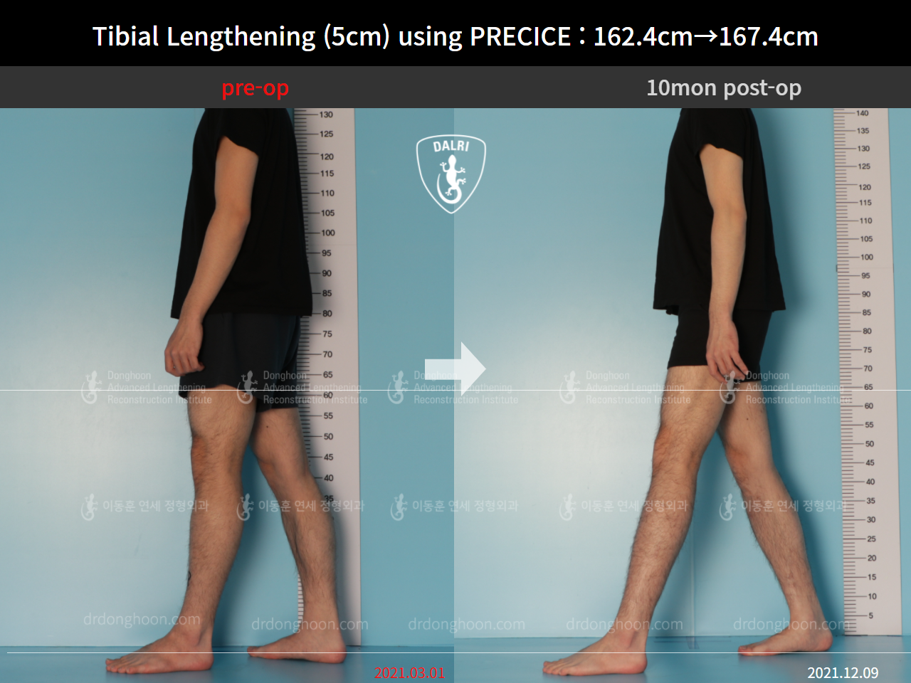 Before and after cll precice, case 9101885, image 3, Dr. Donghoon institute (DALRI)