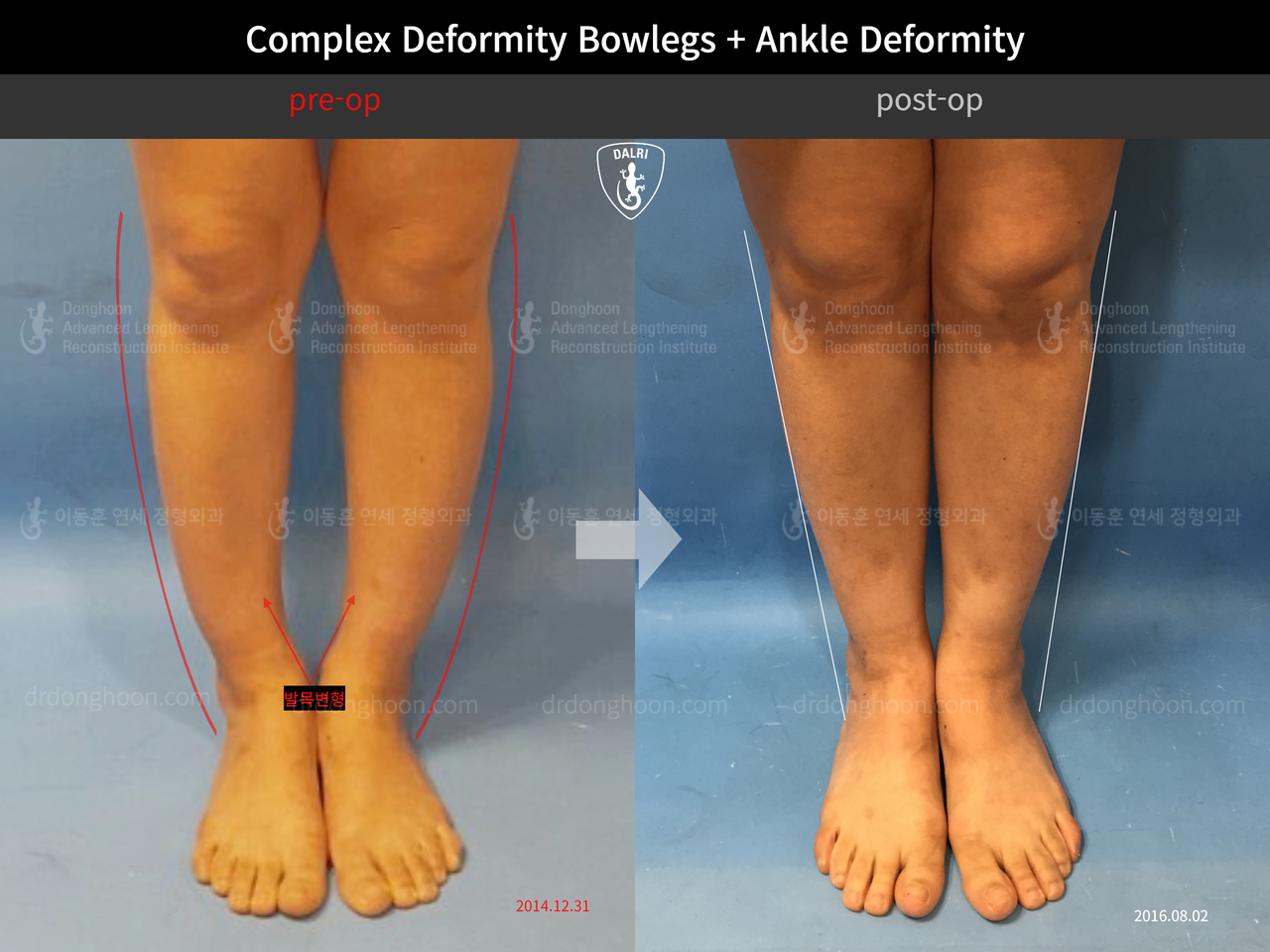 Before and after foot & ankle deformity, case 13215063, image 2, Dr. Donghoon institute (DALRI)