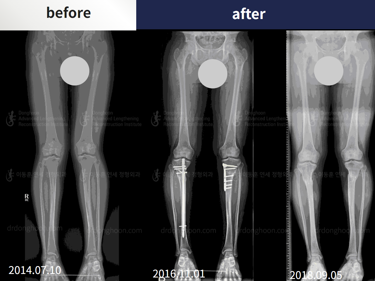 Before and after adult knock knees, case 4586317, image 3, Dr. Donghoon institute (DALRI)