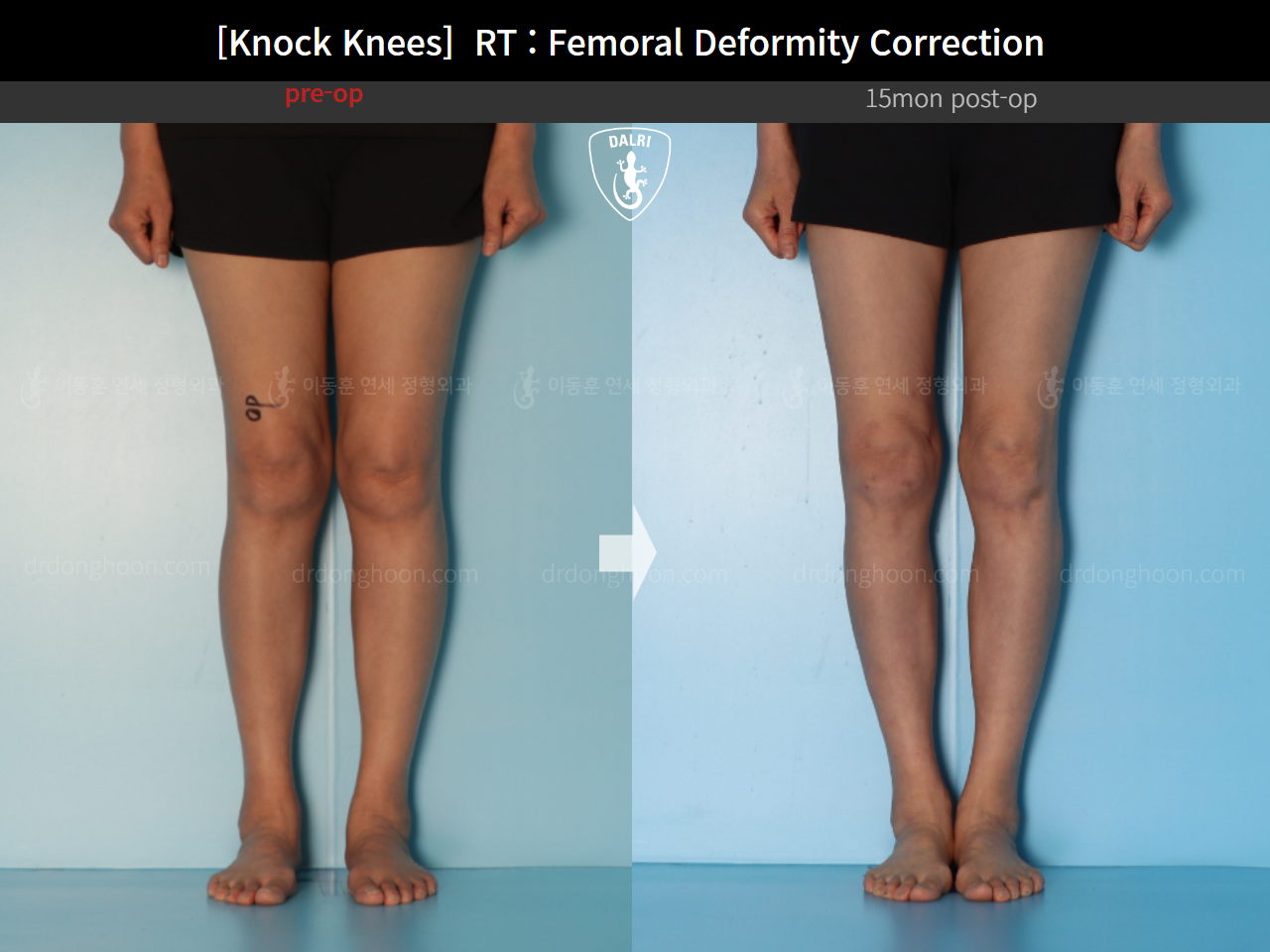 Before and after adult knock knees, case 14462642, image 6, Dr. Donghoon institute (DALRI)