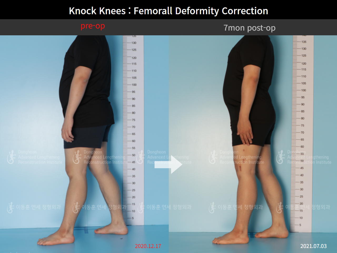 Before and after adult knock knees, case 8821218, image 5, Dr. Donghoon institute (DALRI)