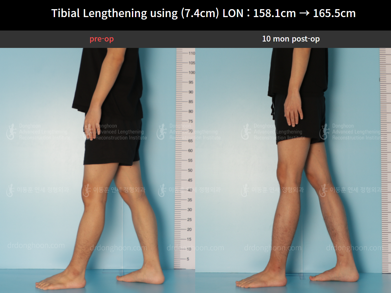Before and after cll lon, case 8559634, image 8, Dr. Donghoon institute (DALRI)