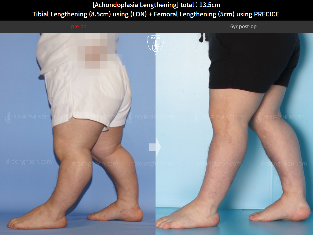 Before and after congenital condition, case 14993507, image 11, Dr. Donghoon institute (DALRI)