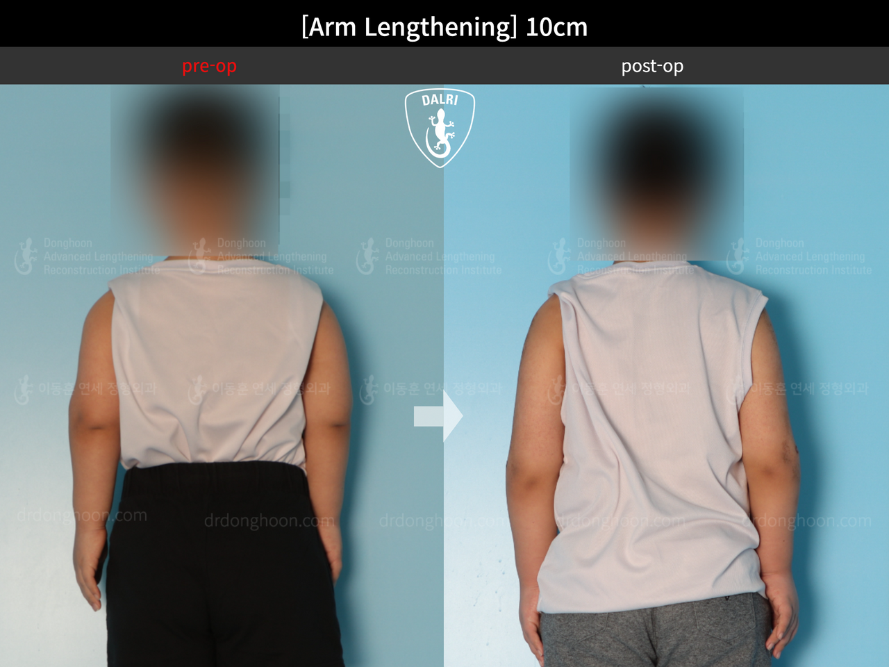 Before and after arm lengthening, case 13536914, image 4, Dr. Donghoon institute (DALRI)