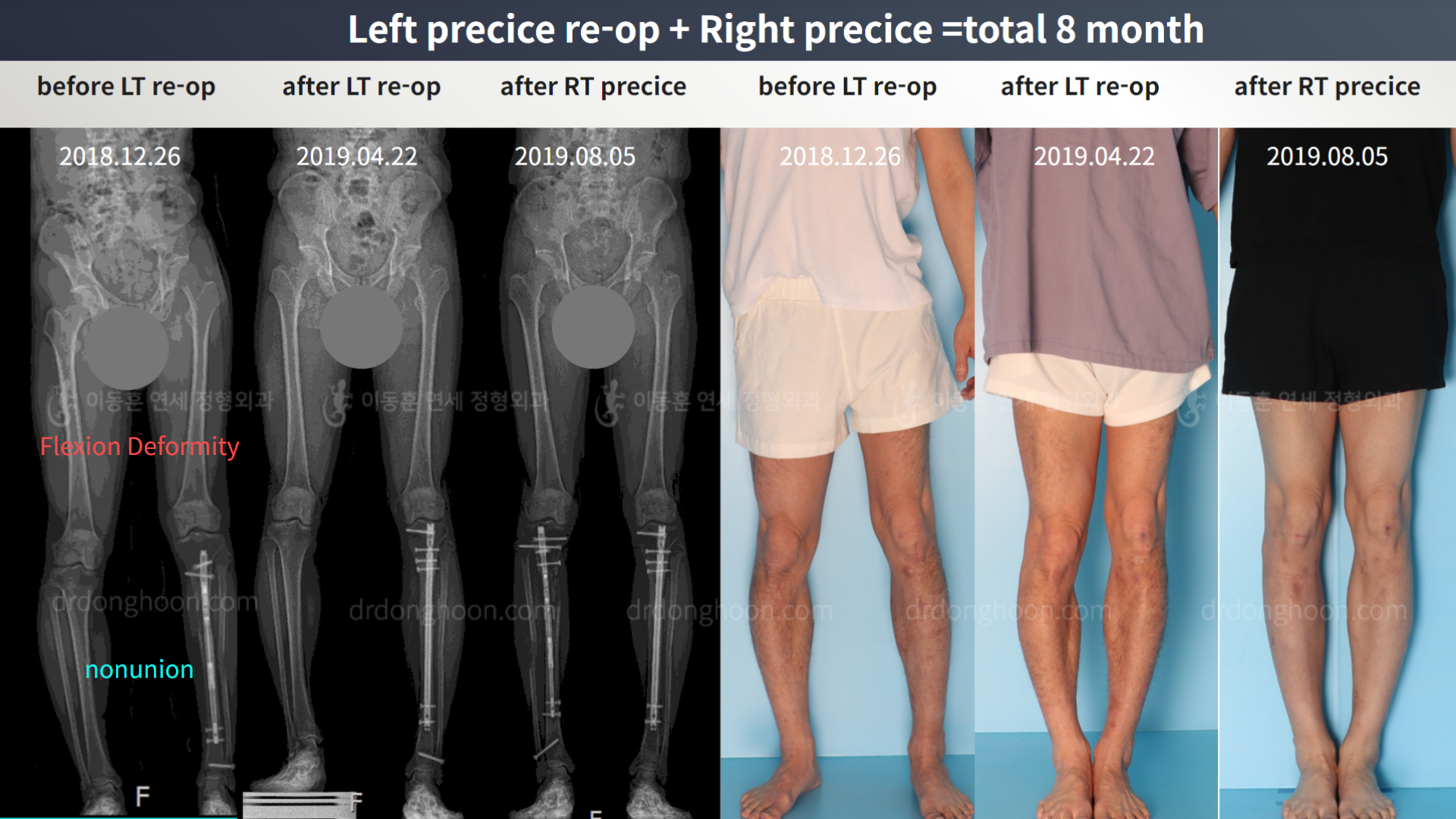 Before and after re-operation for cll, case 4465600, image 2, Dr. Donghoon institute (DALRI)