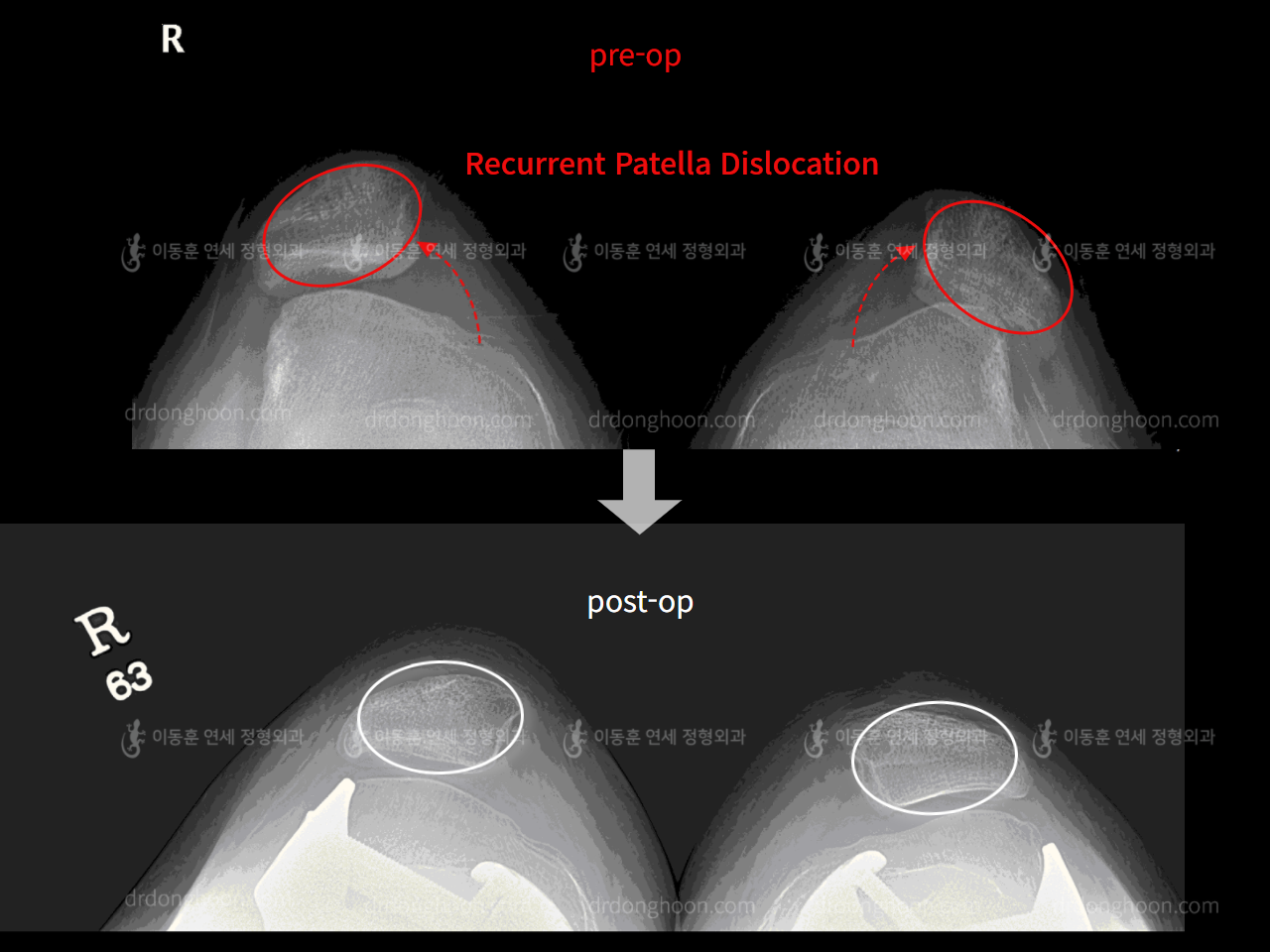 Before and after recurrent patella dislocation, case 4263760, image 7, Dr. Donghoon institute (DALRI)