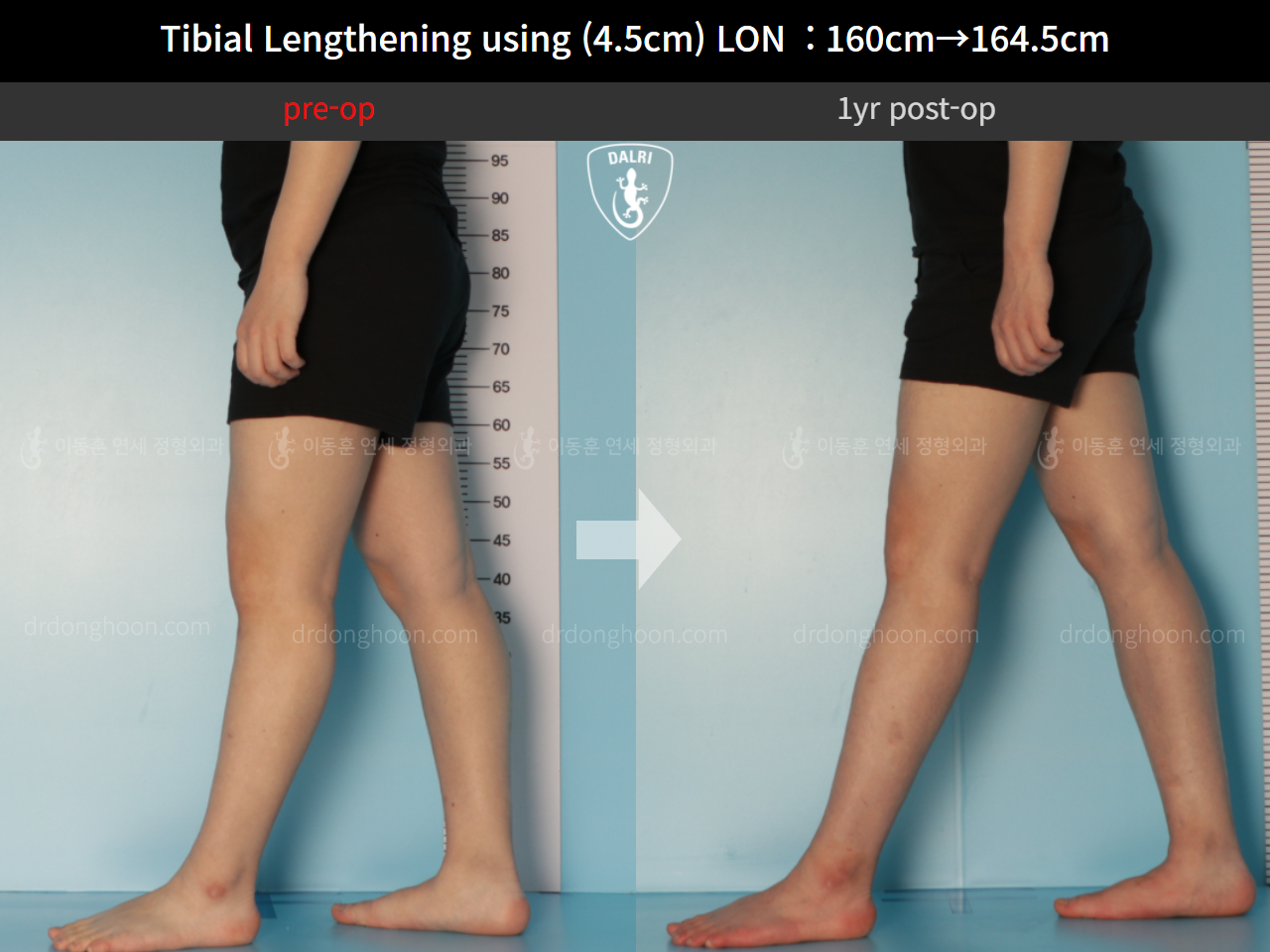 Before and after cll lon, case 10600029, image 7, Dr. Donghoon institute (DALRI)