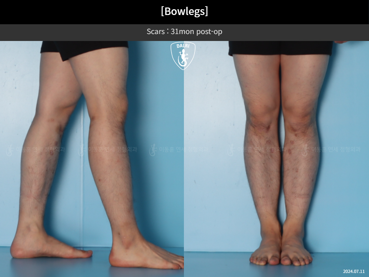 Before and after adult bowlegs, case 44111770, image 9, Dr. Donghoon institute (DALRI)