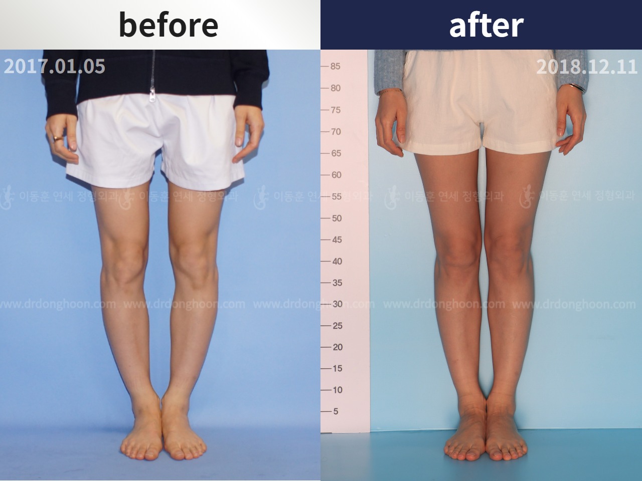 Before and after adult bowlegs, case 4311000, image 1, Dr. Donghoon institute (DALRI)