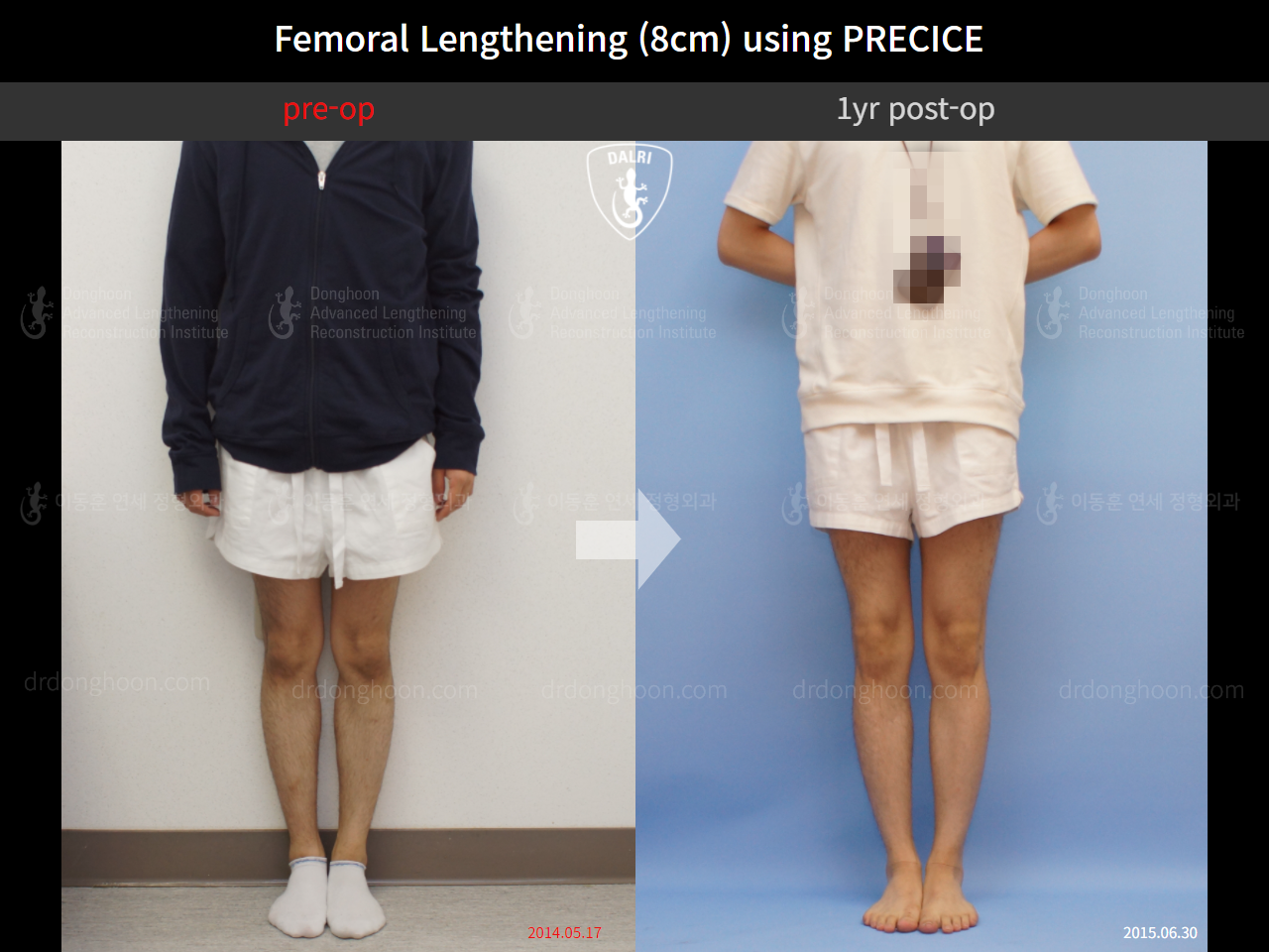 Before and after cll precice, case 4323392, image 1, Dr. Donghoon institute (DALRI)