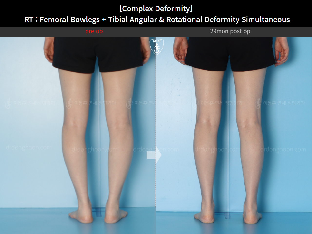 Before and after adult bowlegs, case 14771490, image 10, Dr. Donghoon institute (DALRI)