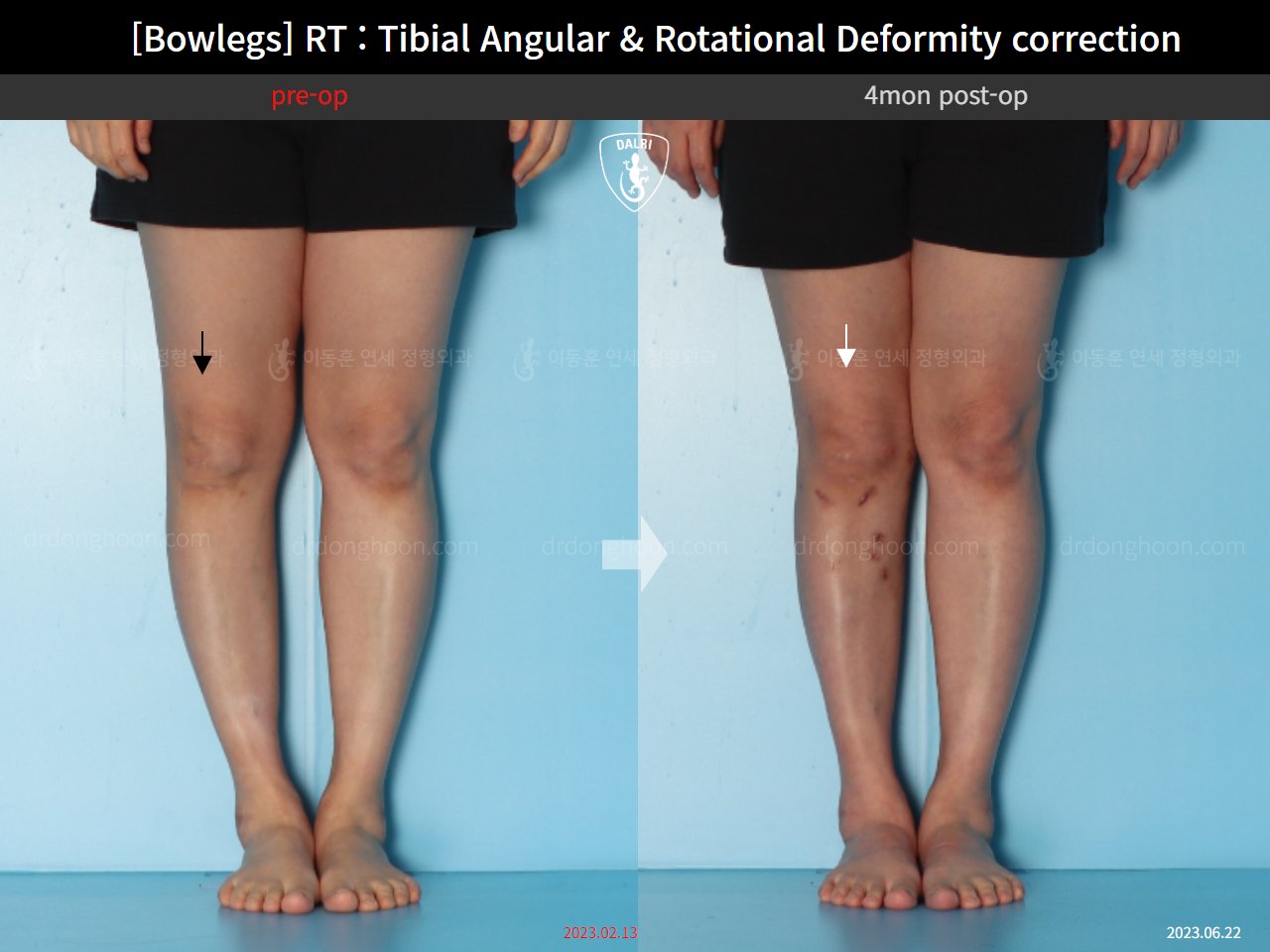 Before and after adult bowlegs, case 15741874, image 6, Dr. Donghoon institute (DALRI)