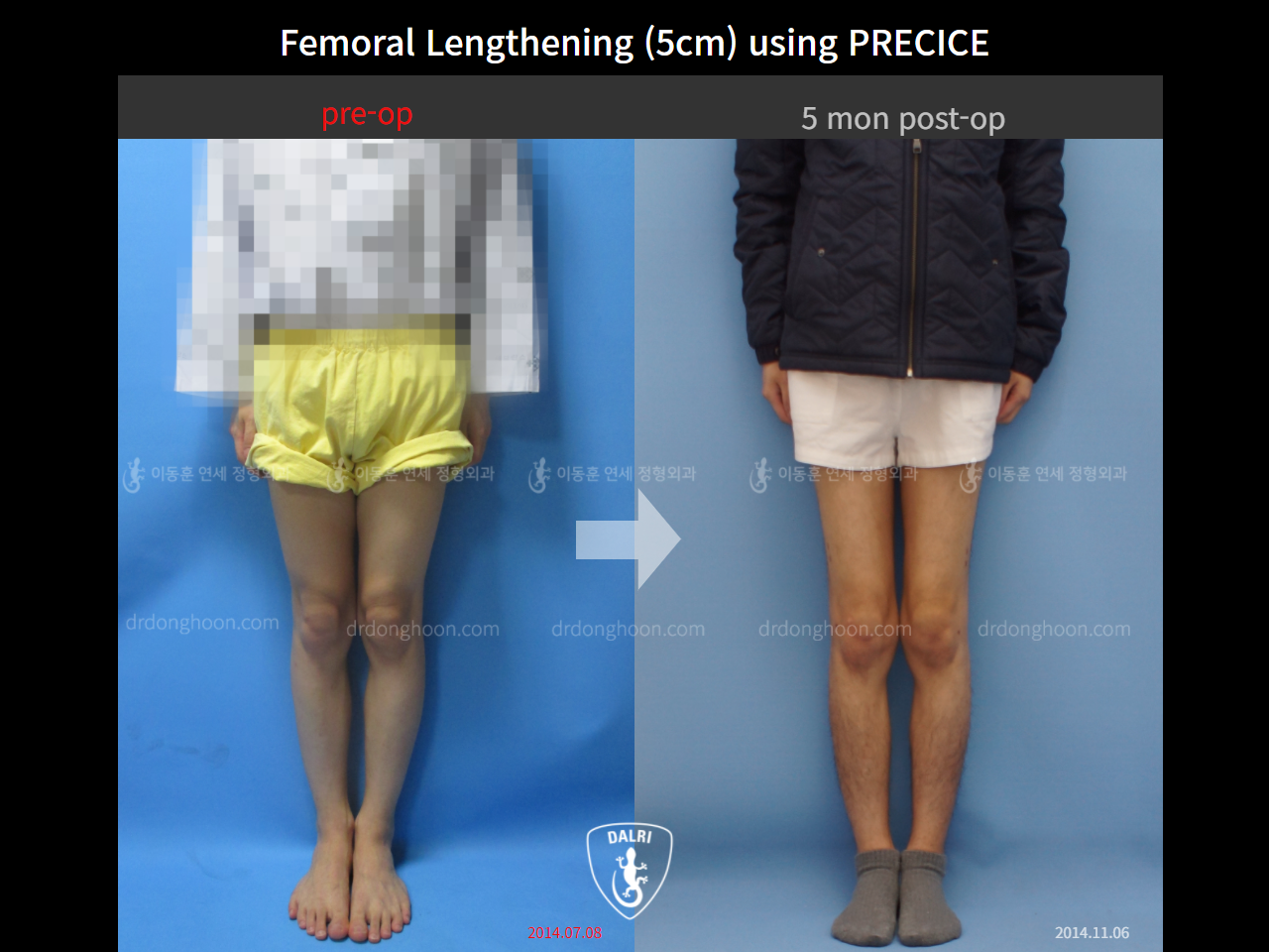 Before and after cll precice, case 9231745, image 1, Dr. Donghoon institute (DALRI)