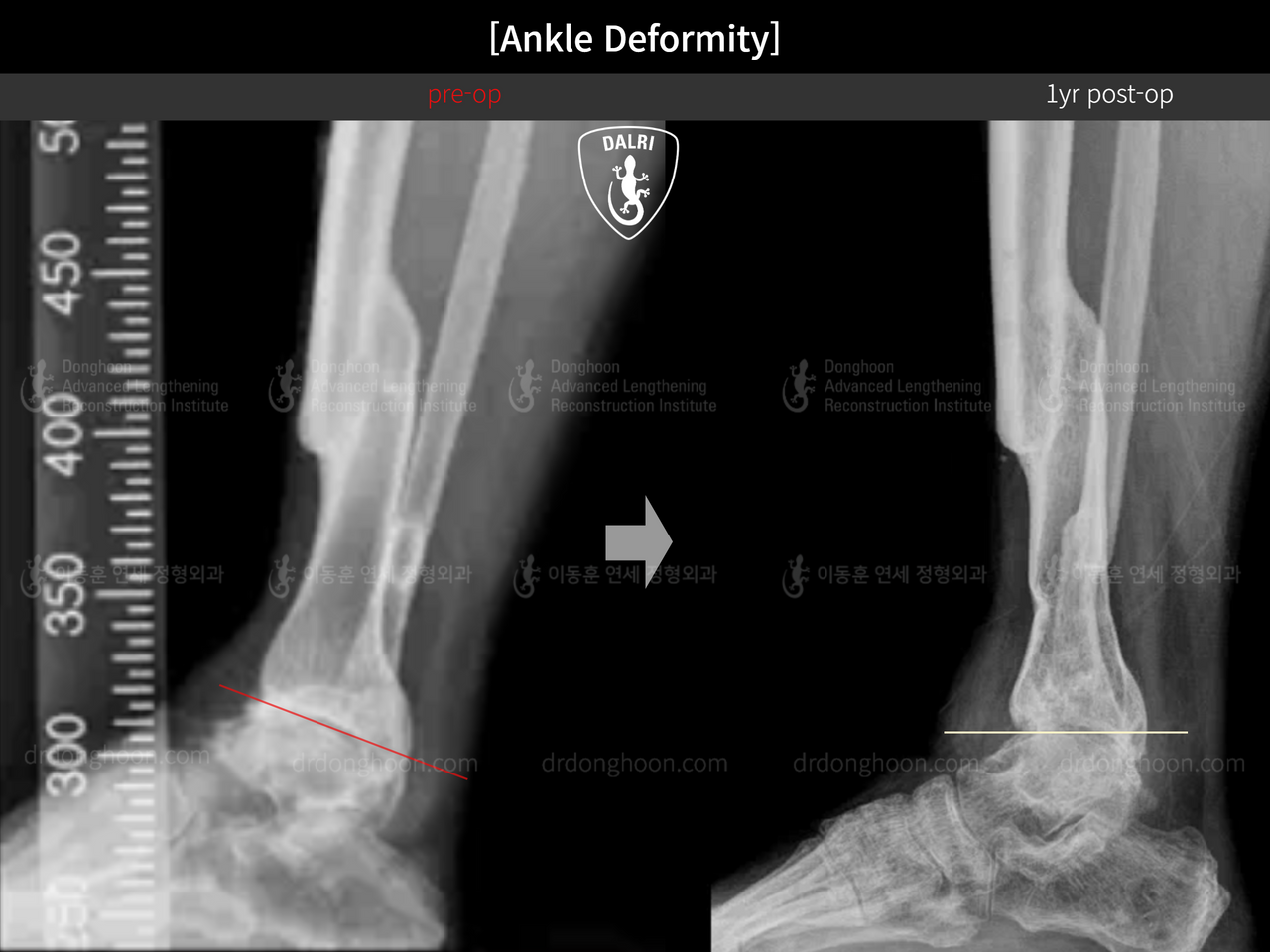 Before and after foot & ankle deformity, case 13580612, image 5, Dr. Donghoon institute (DALRI)