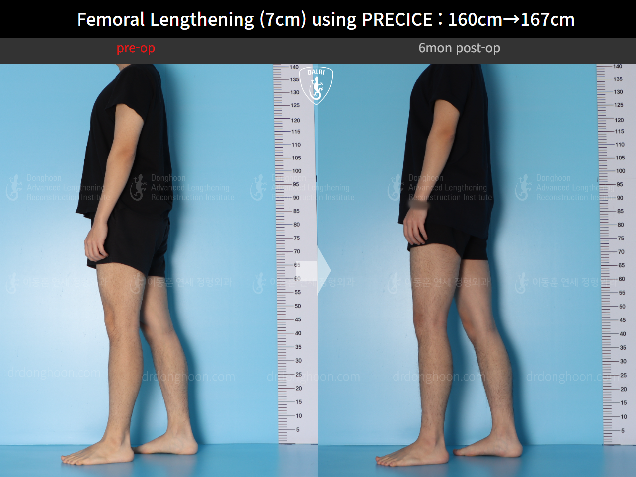 Before and after cll precice, case 15460533, image 5, Dr. Donghoon institute (DALRI)