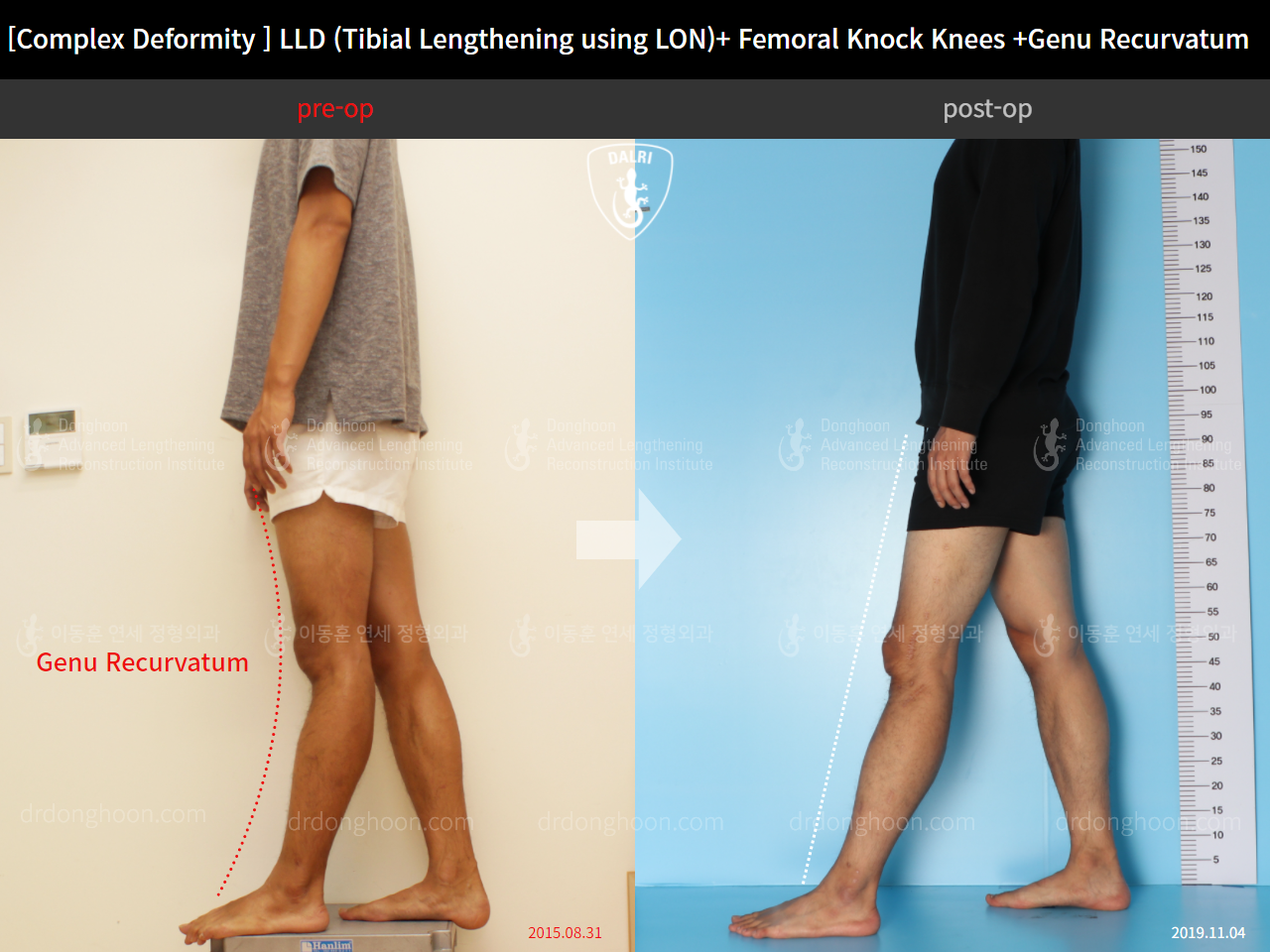 Before and after adult lld, case 4320339, image 3, Dr. Donghoon institute (DALRI)