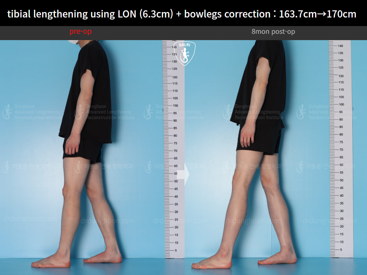 Before and after cll + deformity correction, case 16853829, image 5, Dr. Donghoon institute (DALRI)