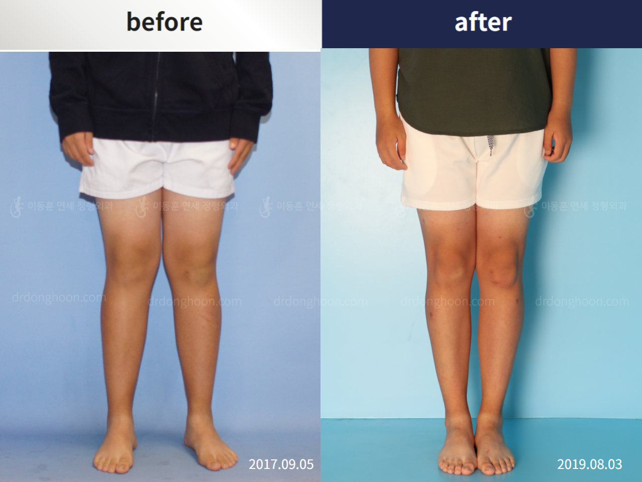 Before and after paediatric & adolescent knock knees, case 5372572, image 1, Dr. Donghoon institute (DALRI)