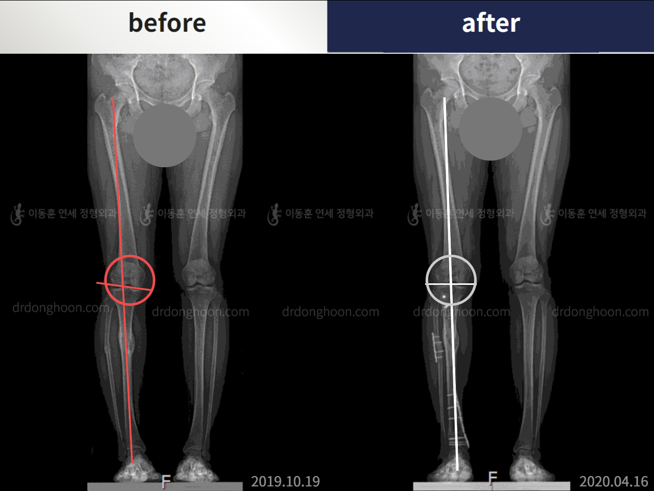 Before and after osteotomy for knee osteoarthritis, case 5203391, image 1, Dr. Donghoon institute (DALRI)