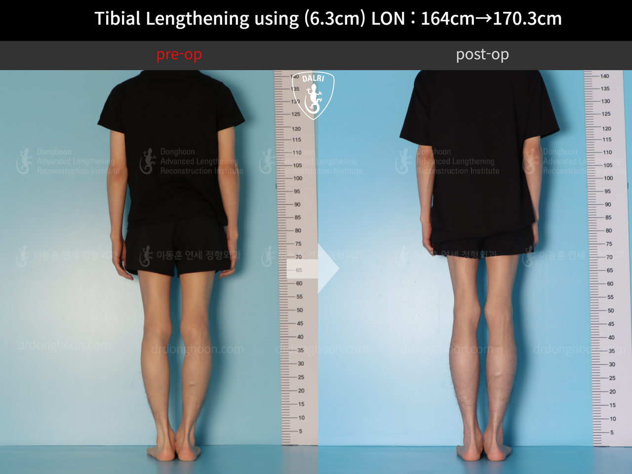 ภาพก่อน-หลัง ยืดขาเทคนิค LON เคสที่ 12402410 ภาพที่ 3 จากโรงพยาบาลศัลยกรรมกระดูกลีดงฮุน (DALRI)