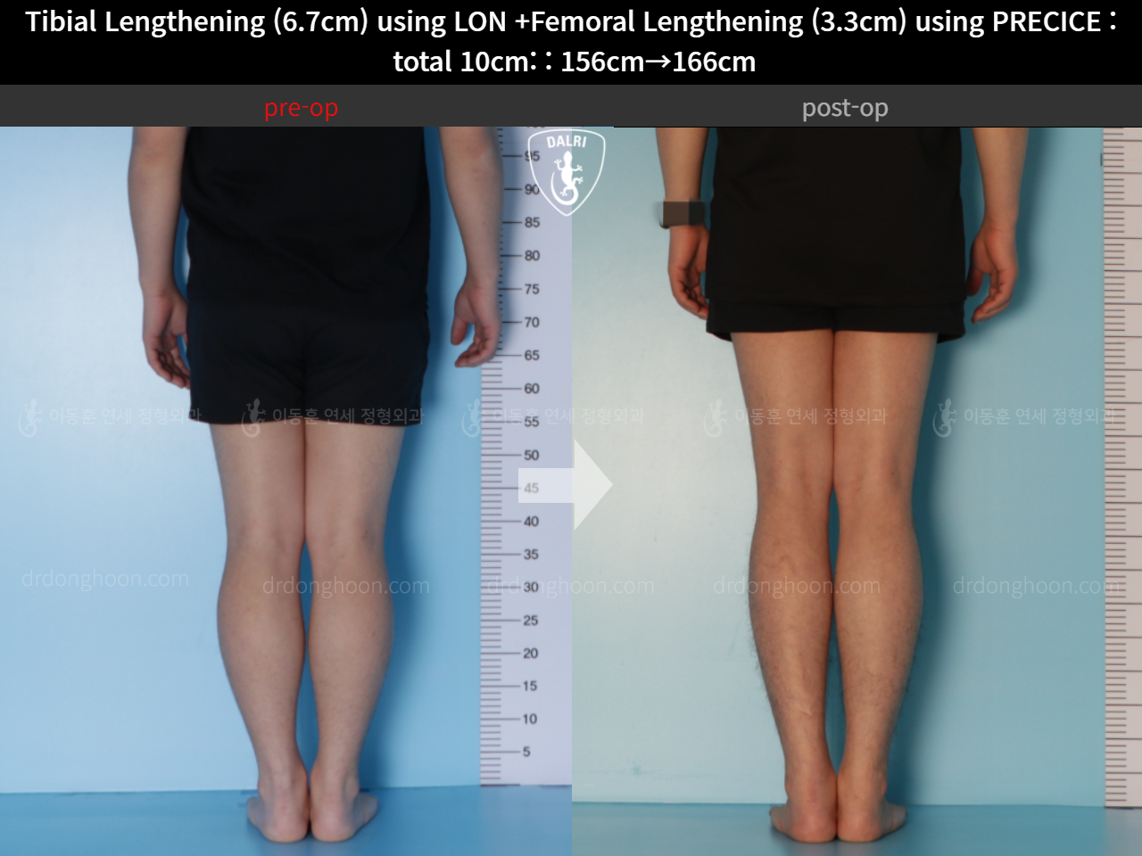 Before and after cll lon, case 11044268, image 6, Dr. Donghoon institute (DALRI)