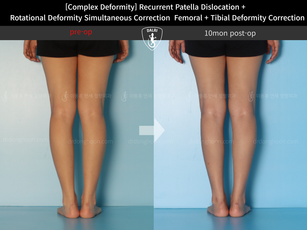 Before and after complex deformity, case 12860892, image 7, Dr. Donghoon institute (DALRI)