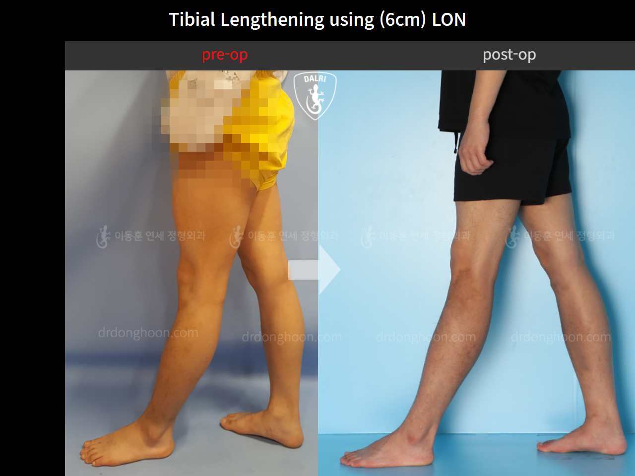 Before and after cll lon, case 11087271, image 8, Dr. Donghoon institute (DALRI)