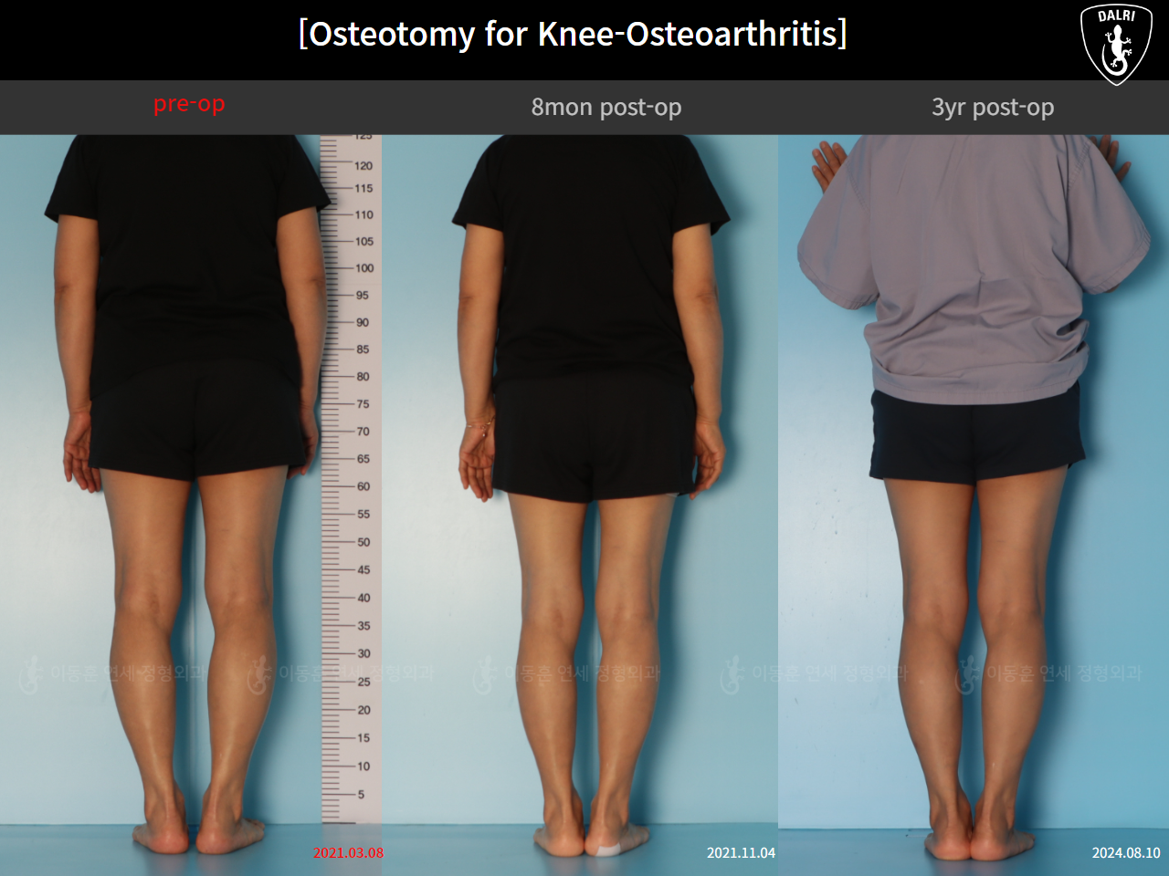 Before and after osteotomy for knee osteoarthritis, case 85842641, image 2, Dr. Donghoon institute (DALRI)