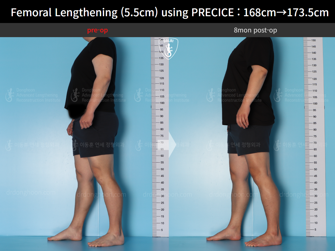 Before and after cll precice, case 16910900, image 4, Dr. Donghoon institute (DALRI)