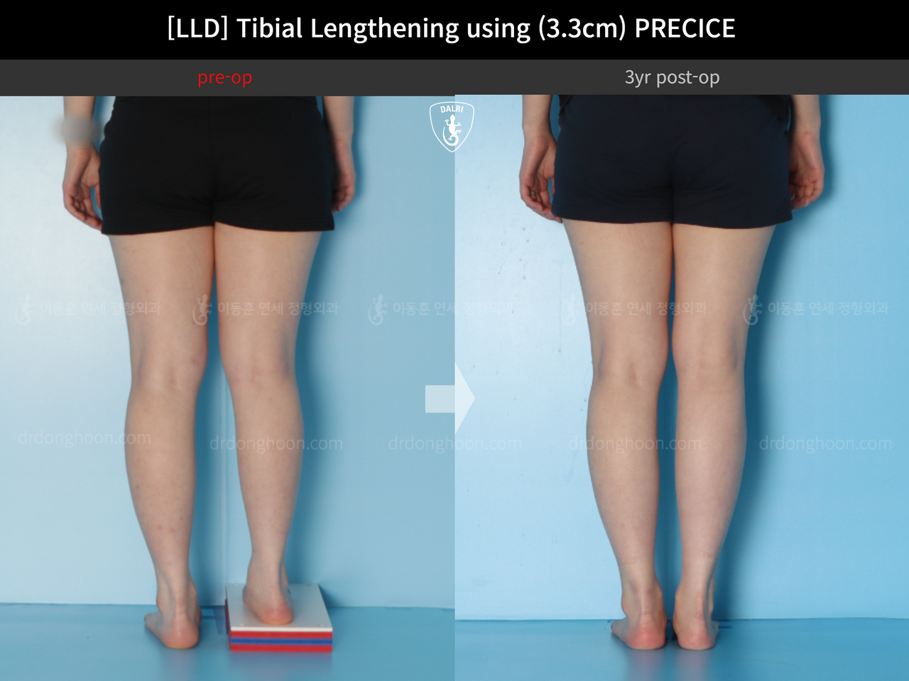 Before and after adult lld, case 14064905, image 8, Dr. Donghoon institute (DALRI)